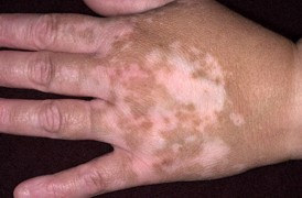 Watt Give Datum Vitiligo - Skin Care Center