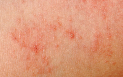 allergic rash dermatitis skin texture